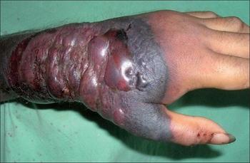 ebola-hand1.jpg